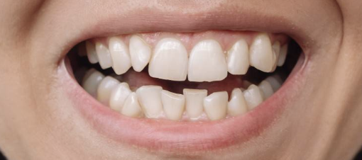 Prime Dental Clear aligners before